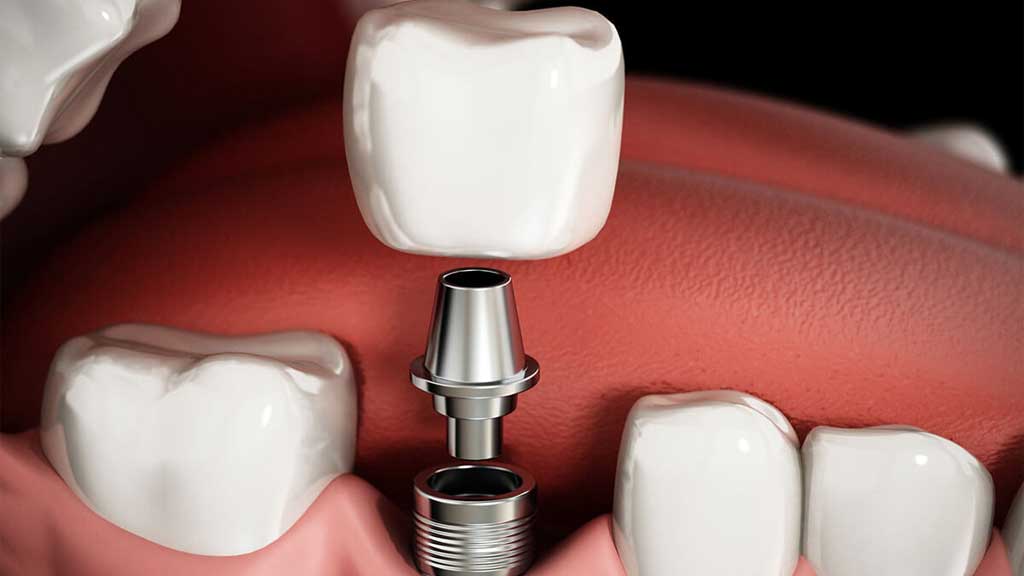 بهترین متخصص ایمپلنت شیراز - [1403]⭐