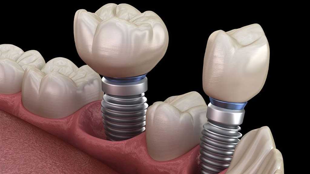 بهترین متخصص ایمپلنت شیراز - [1403]⭐