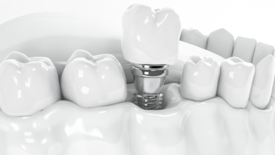 بهترین متخصص ایمپلنت شیراز