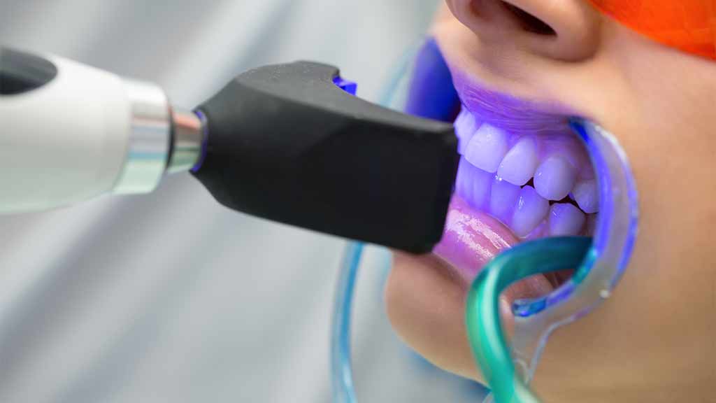 بلیچینگ دندان در شیراز ⭐ [1403]