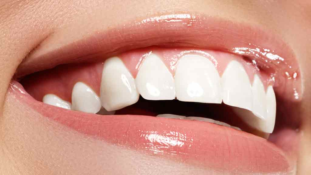 بلیچینگ دندان در شیراز ⭐ [1403]