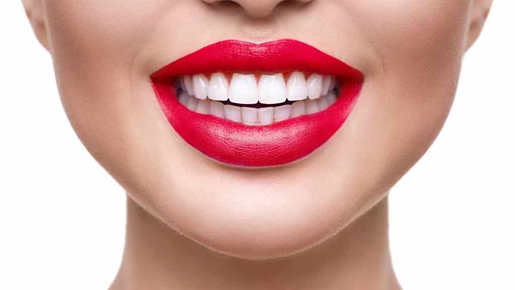 بلیچینگ دندان در شیراز ⭐ [1403]