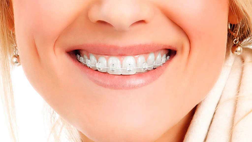 ارتودنسی دندان در شیراز