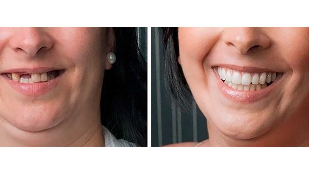 عکس ایمپلنت کره ای قبل و بعد