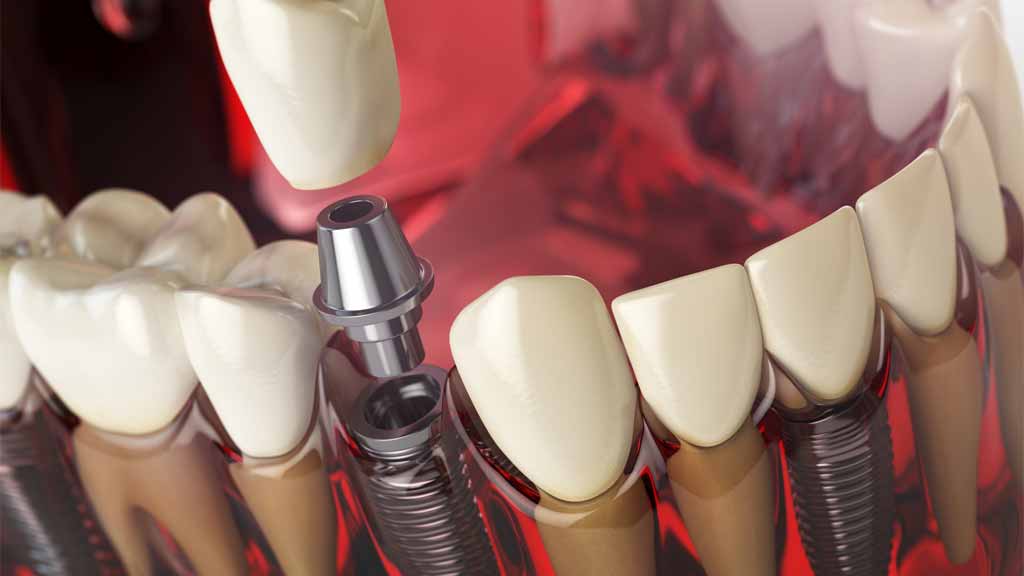 قیمت ایمپلنت کره ای در شیراز ⭐️【آپدیت1403】