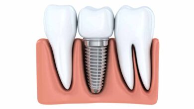 قیمت ایمپلنت کره ای در شیراز ⭐️【آپدیت1403】