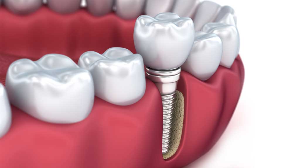 قیمت ایمپلنت کره ای در شیراز ⭐️【آپدیت1403】
