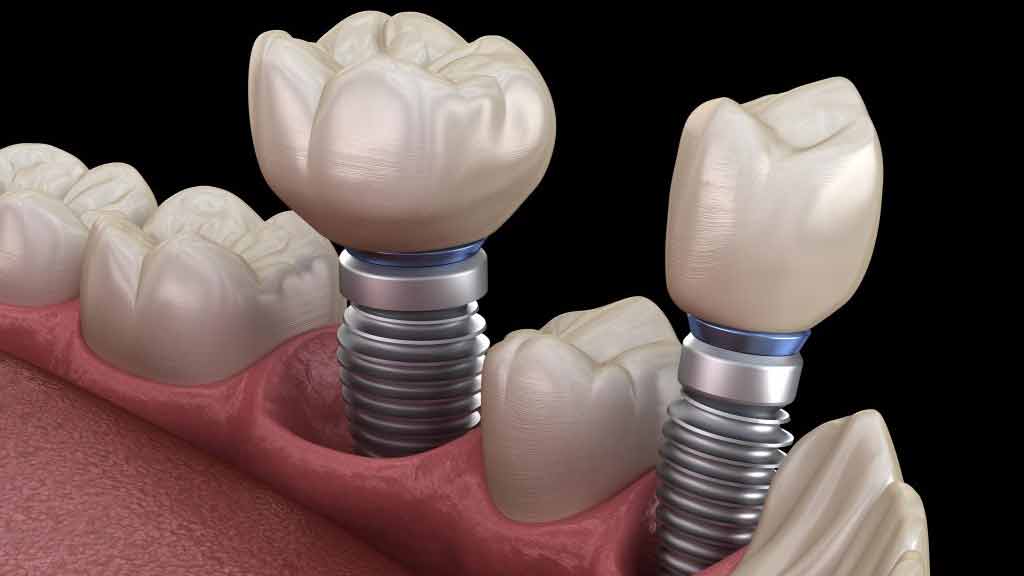 قیمت ایمپلنت سوئیسی در شیراز ⭐️【آپدیت1404】