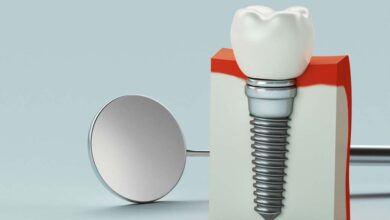 قیمت ایمپلنت دندان در شیراز ⭐️【آپدیت1403】