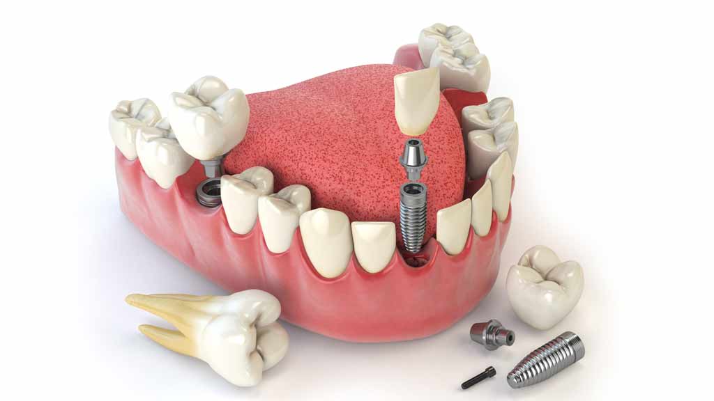 قیمت ایمپلنت دندان در شیراز ⭐️【آپدیت1403】