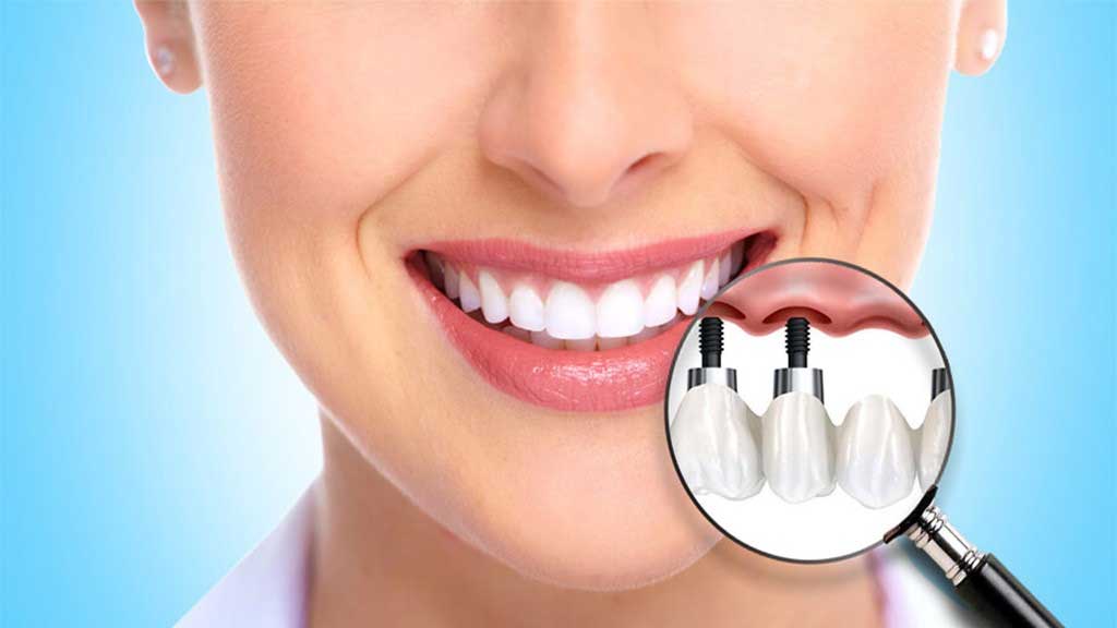 قیمت ایمپلنت دندان در شیراز ⭐️【آپدیت1403】