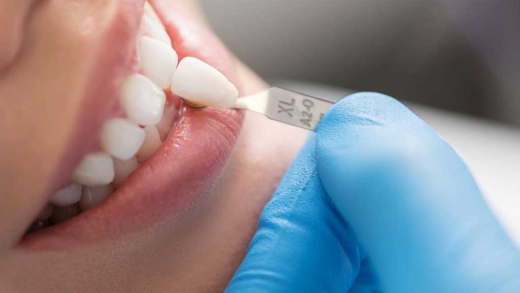 ترمیم لمینت دندان در شیراز ⭐ [1403]