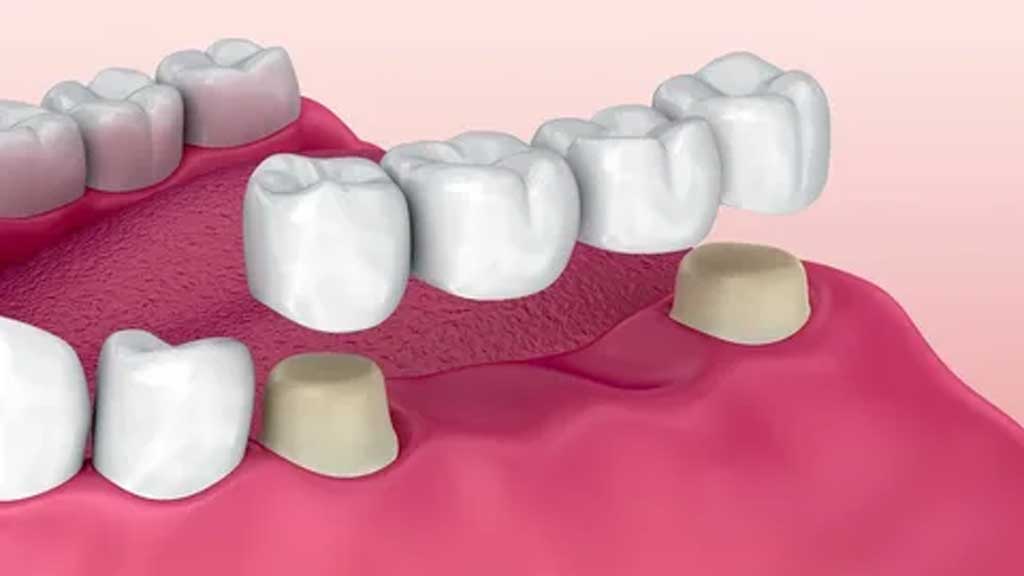 دندانپزشک بریج دندان در شیراز ⭐️【آپدیت1403】