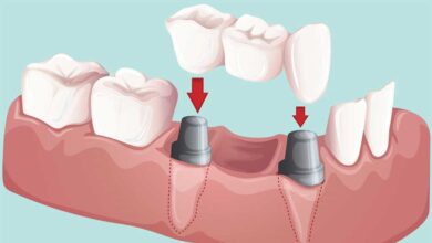 دندانپزشک بریج دندان در شیراز ⭐️【آپدیت1403】