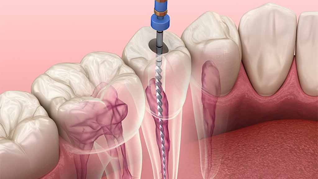 دندانپزشک عصب کشی دندان در شیراز ⭐️【آپدیت1403】