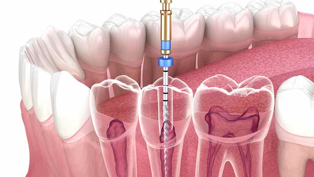 دندانپزشک عصب کشی دندان در شیراز ⭐️【آپدیت1403】