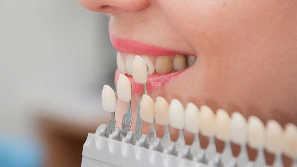 معرفی بهترین دندانپزشک لمینت دندان در شیراز ⭐ [1403]