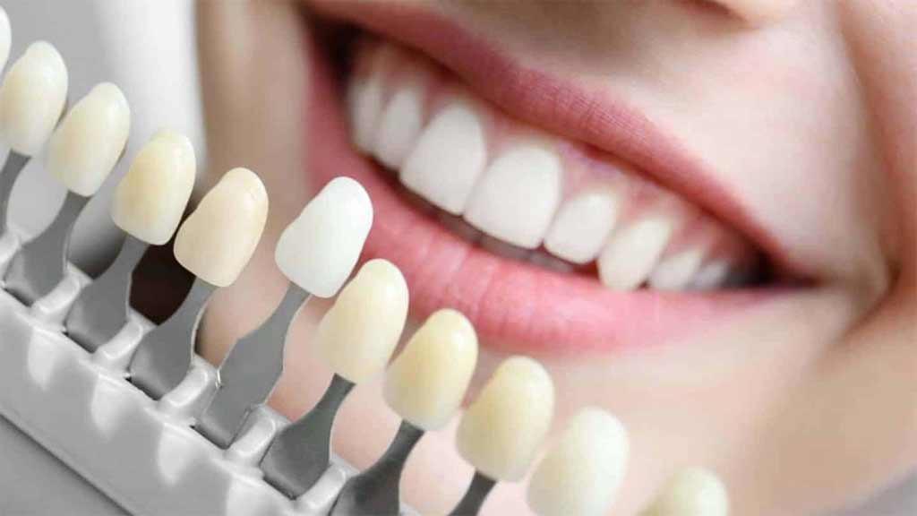 معرفی بهترین دندانپزشک لمینت دندان در شیراز ⭐ [1403]