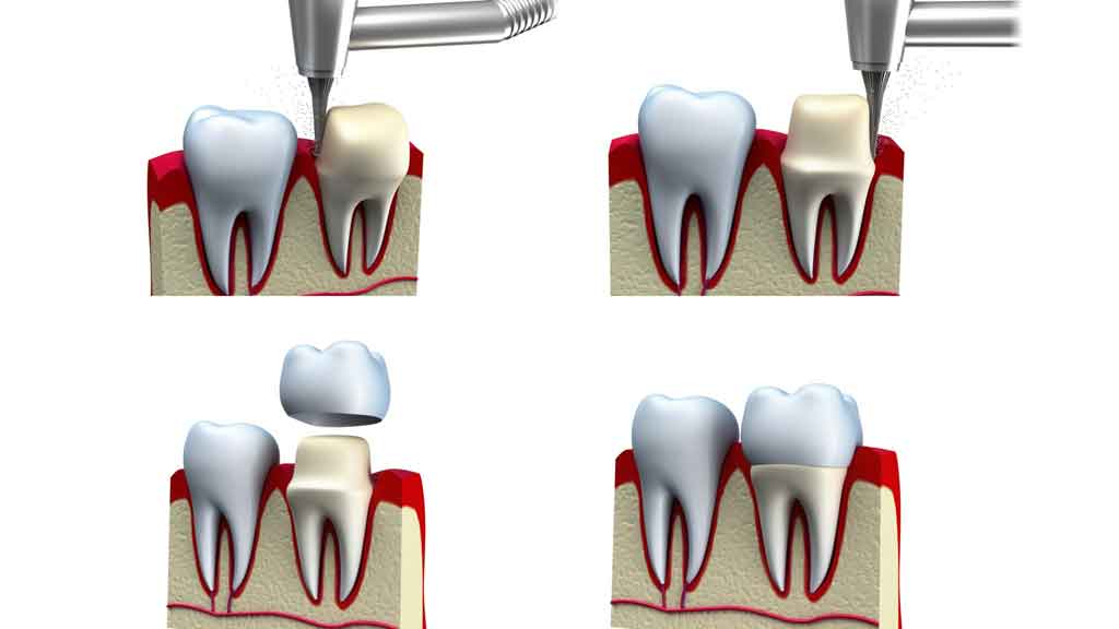 بهترین دندانپزشک متخصص روکش دندان در شیراز ⭐ [1403]