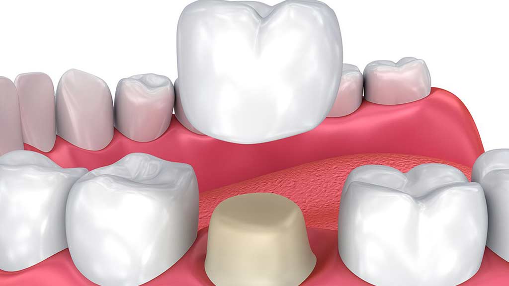 بهترین دندانپزشک متخصص روکش دندان در شیراز ⭐ [1403]