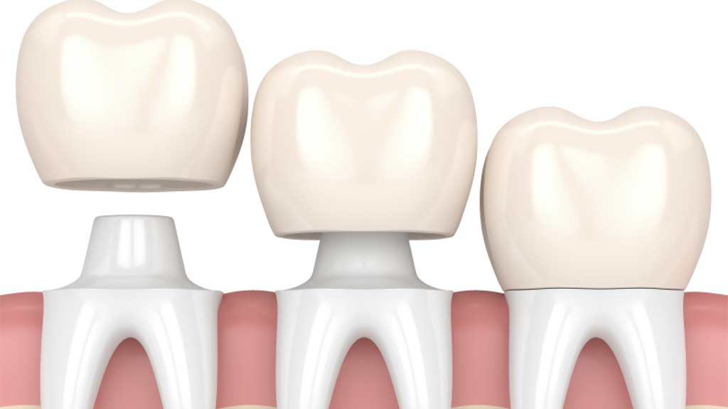 بهترین دندانپزشک متخصص روکش دندان در شیراز ⭐ [1403]