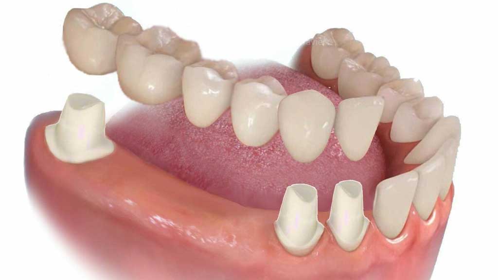 بهترین دندانپزشک پروتز دندان در شیراز ⭐ [1403]