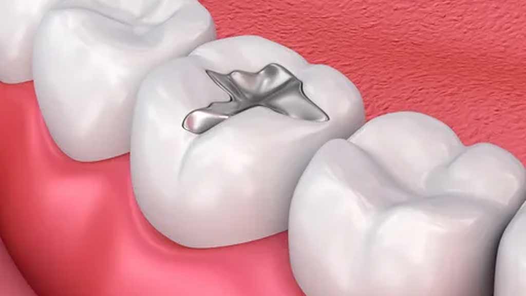 دندانپزشک پر کردن دندان در شیراز⭐️【آپدیت1403】