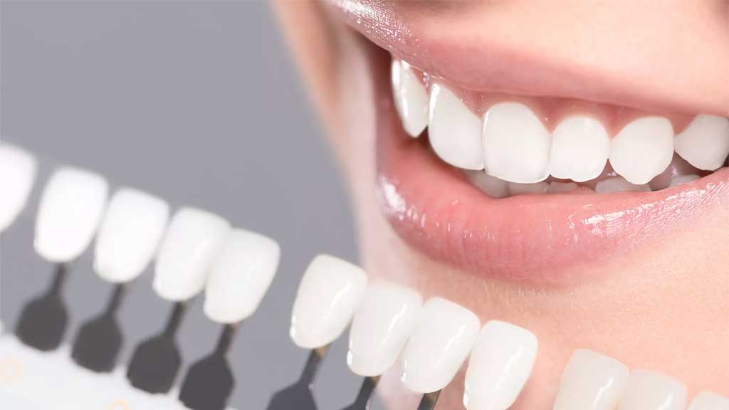 لمینت دندان اقساطی در شیراز