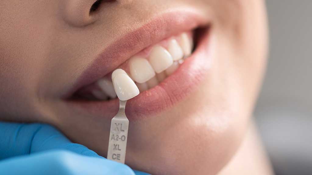 لمینت دندان اقساطی در شیراز