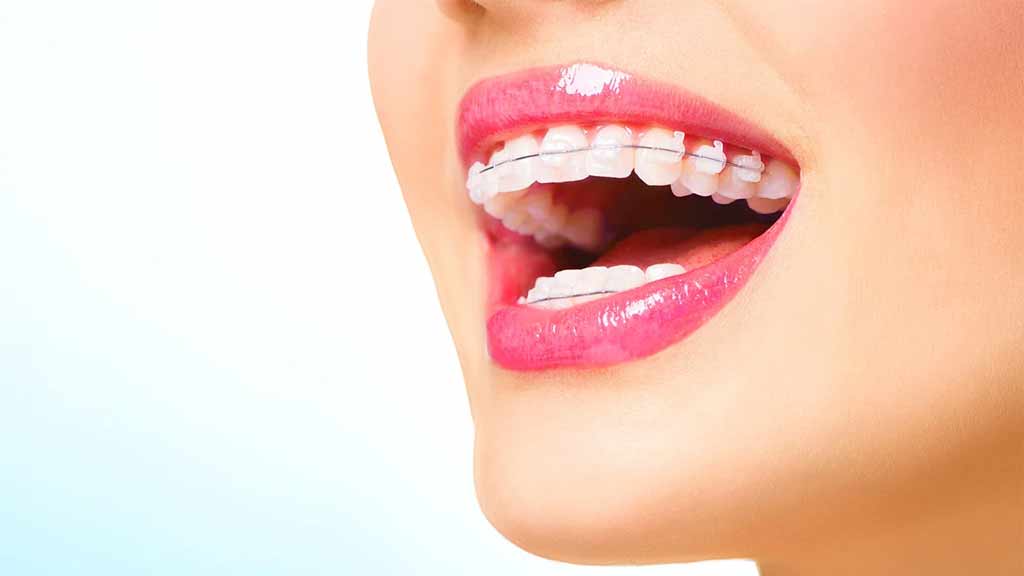 ارتودنسی دندان اقساطی در شیراز ⭐️【آپدیت1403】