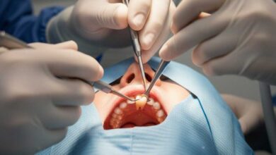 جراحی دندان عقل در صدرا